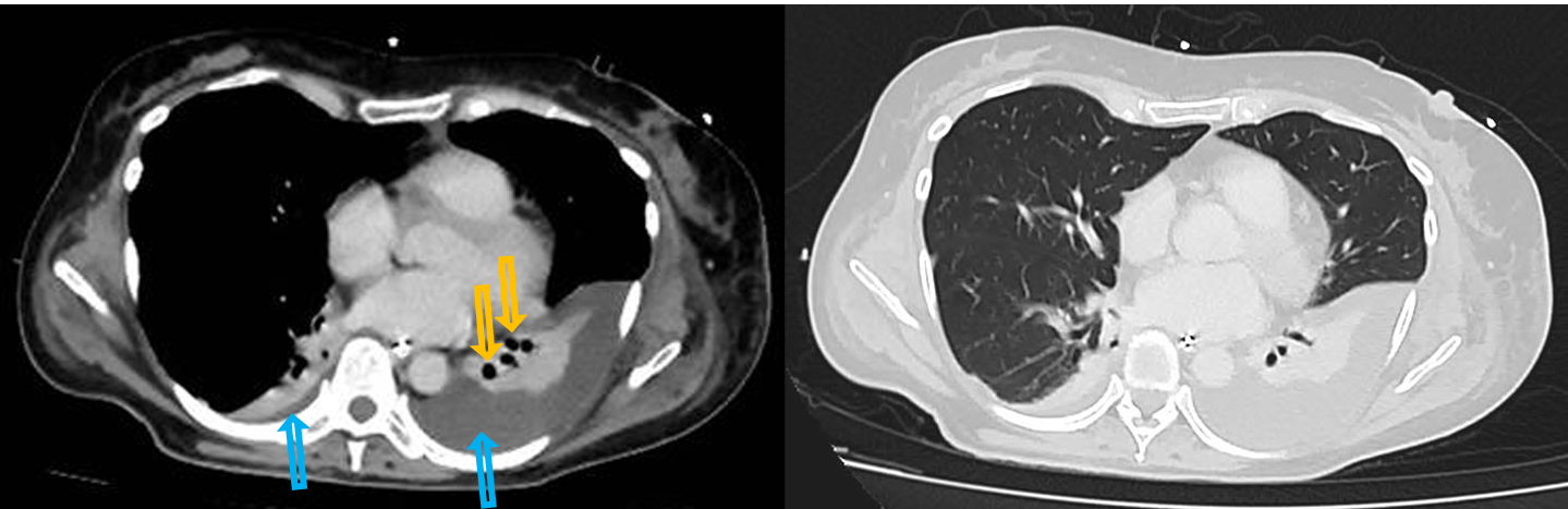 <p>Patient history: postoperative CT scan after abdominal surgery </p><p>Modality : left – contrast-enhanced CT, soft tissue window; right – contrast-enhanced CT, lung window</p><p> Region: chest, axial planes </p><p>Radiologic sign: Minimal pleural effusion on the right side with an approximate density of 0 HU (blue arrow). 3 cm-wide pleural effusion on the left side (blue arrow), left lower lobe is devoid of air, air bronchograms can be seen (yellow arrows). </p><p>Diagnosis: bilateral hydrothorax with concomitant left lower lobe atelectasis</p>