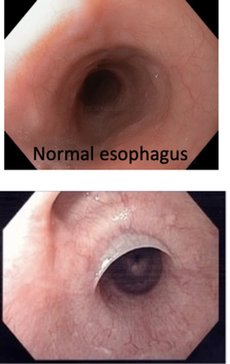 <p>Patient presents with proximal membrane formation and they have an untreated iron-deficiency anemia known as plummer-Vinson syndrome (anemia, hand abnormalities, risk for cancer). What is the diagnosis?</p>
