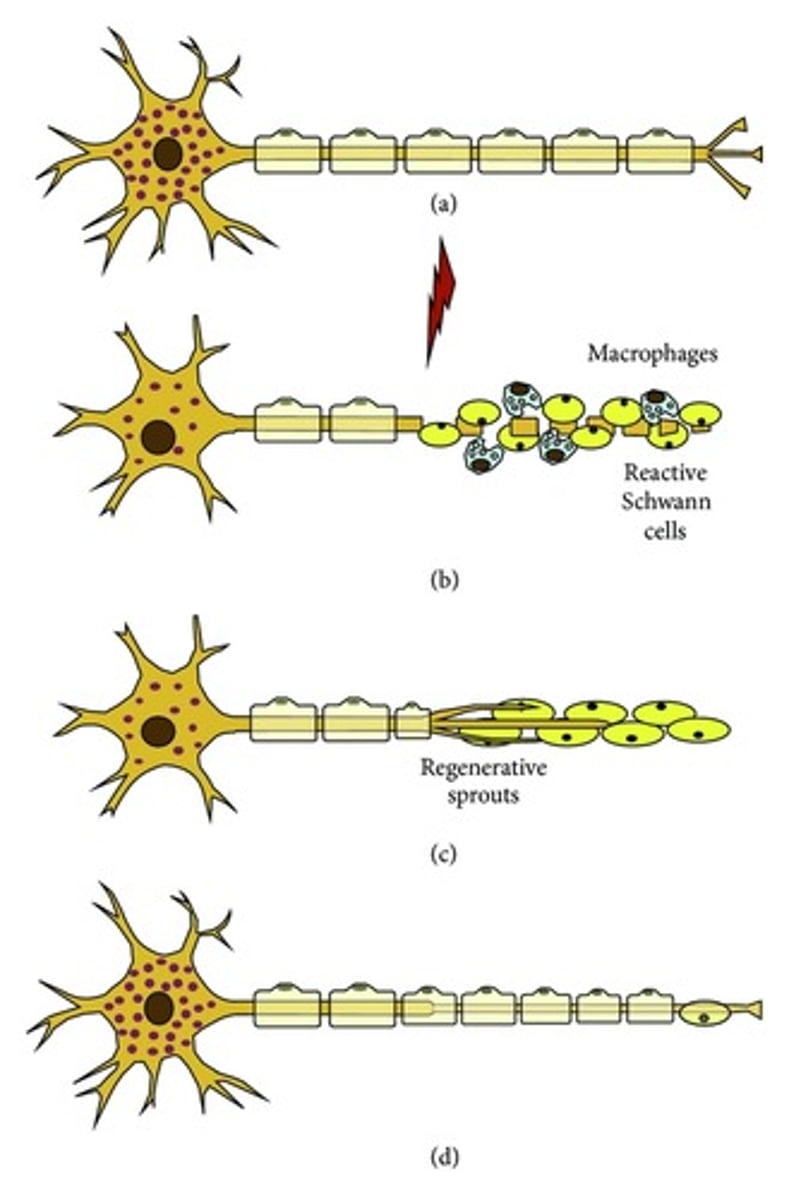 <p>degeneration of the distal portion of the axon and myelin sheath</p>