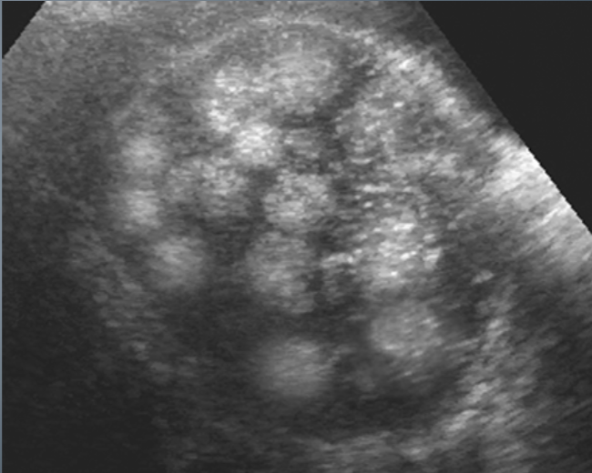 <ul><li><p>varies</p></li><li><p>cystic mass</p></li><li><p>complex mass w/ calcifications</p></li><li><p>fat-fluid level within complex mass</p></li><li><p>diffusely echogenic mass w/o shadowing</p></li><li><p>predominantly solid with echogenic foci that represent calcium or fat with or without shadowing</p></li><li><p><span style="color: #ff0000">“Tip of the Iceberg”</span></p></li></ul><p></p>