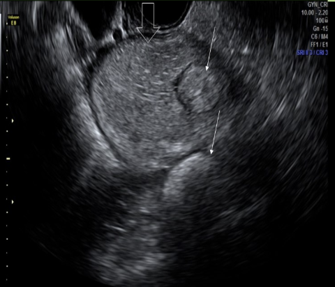 <p>an ovarian mass w/<strong>dot-dash pattern</strong> internally is most likely</p><p>a) mucinous adenoma</p><p>b) dysgerminoma</p><p>c) teratoma</p><p>d) mucinous adenocarcinoma</p>