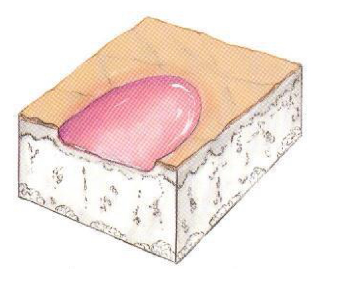 <p>what type of skin lesion is this? </p>