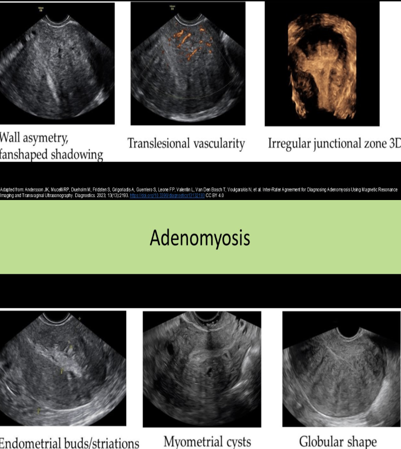 <p>d) adenomyosis</p>