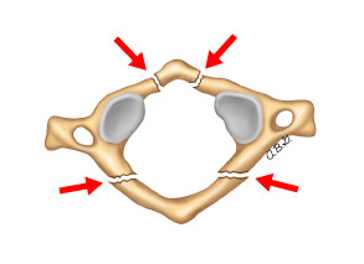 <p>Fracture of the anterior and posterior arches of C1</p><p>Usually bilateral, 4 possible fracture locations</p>