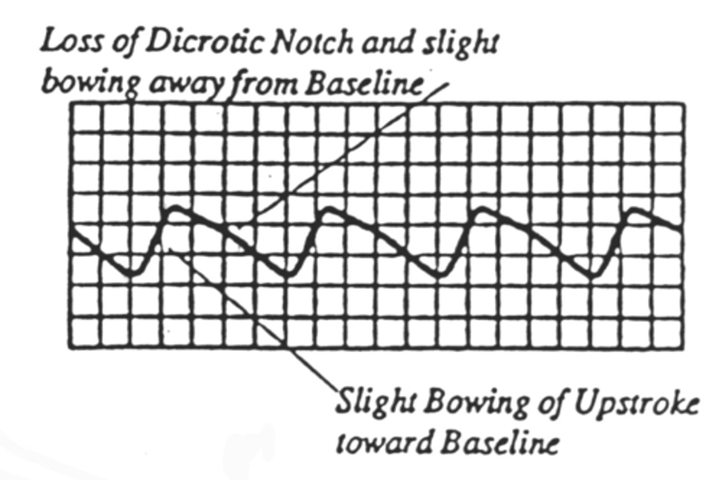 <p>Monophasic flow (looks like tardus parvus)</p><p>Loss of dicrotic notch</p><p>Slightly delayed upstroke</p><p>Downstroke bows away from baseline</p><p>Sharp peak</p><p>May decrease in amplitude</p>