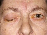 <p>cannot open affected eye, pupil depressed and abducted and dilated</p>