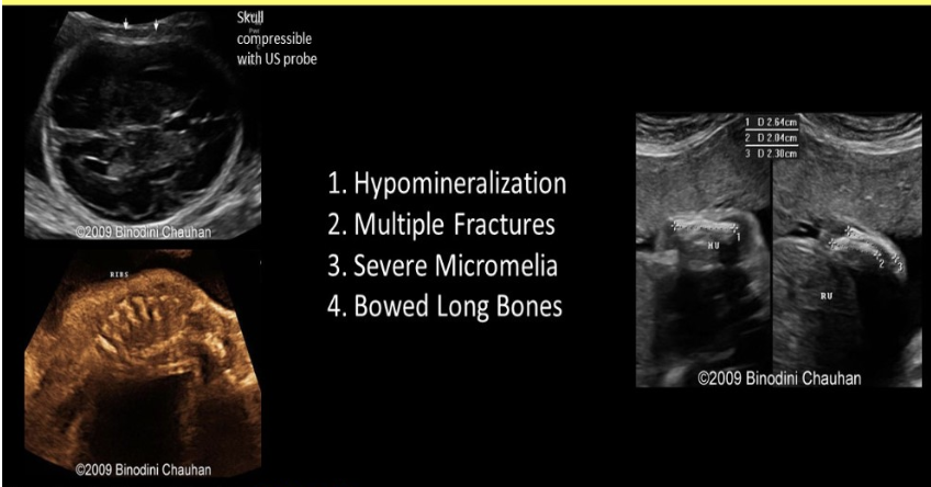 <p>which refers to <strong>hypophosphatasia</strong></p><p>.</p><p>a) congenital bowel defect that causes abn filtration of phosphates + polyhydramnios</p><p>b) congenital kidney defect that causes abn filtration of phosphates + polyhydramnios</p><p>c) increased echogenicity w/excessive posterior shadowing from skull + long bones</p><p>d) poor skull ossification leads to increased echogenicity of the falx cerebri</p>