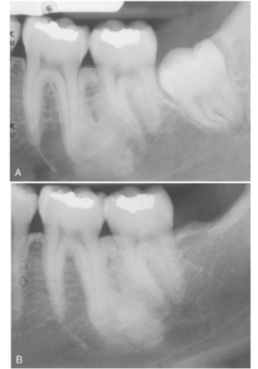 <p>Where are most cases of Idiopathic Osteosclerosis found?</p>