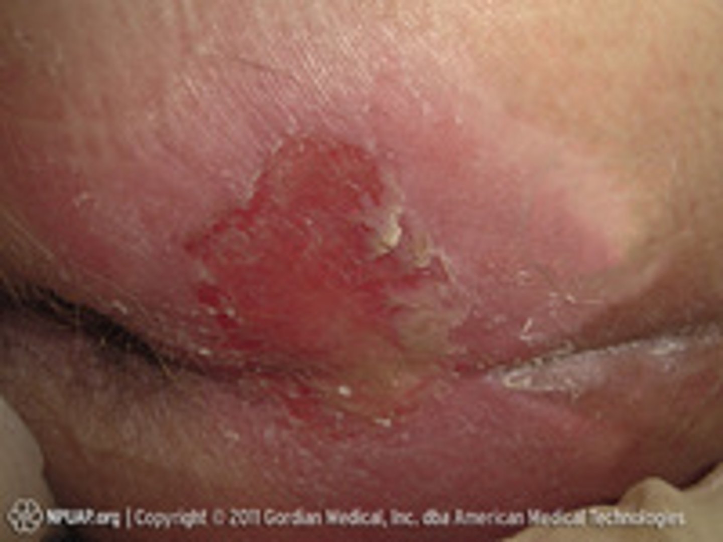 <p>These wounds look like a reddened area or a scrape where the very top layer of skin has been removed, but the integrity of the deeper, blood-vessel-containing dermis remains intact.</p>