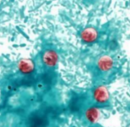 <p>(Tổng hợp 5) Bệnh nhân nữ 25 tuổi, bị tiêu chảy phân nước khoảng 7 ngày nay, bệnh nhân bị bệnh Lupus hệ thống đang điều trị. Xét nghiệm phân và nhuộm, quan sát dưới kính hiển vi thấy cấu trúc màu đỏ hình vệt trong trứng nang, đó là:</p>
<p>A. Thoa trùng<br />
B. Bào tử nang<br />
C. Thể hoạt động<br />
D. Thỏi chromatoid</p>