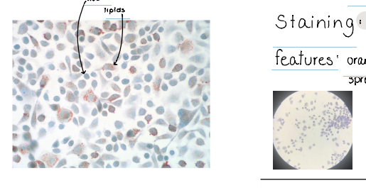 <p>Lipid Inclusions </p><p>staining : Sudan hematoxylin </p><p>features : orange lipid drops in different sizes aren't spread in the whole cell, blue nucleus</p>