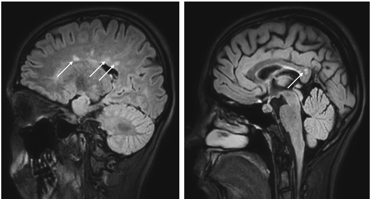 <p>This MRI, FLAIR sequence, imaging shows?</p>