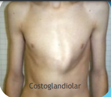 <p>Affects the body of the sternum </p>