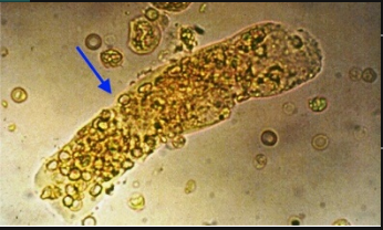 <p>What type of cast is shown in the illustration?</p><p>WBC cast</p><p>RBC cast</p><p>Waxy cast</p><p>Granular cast</p>