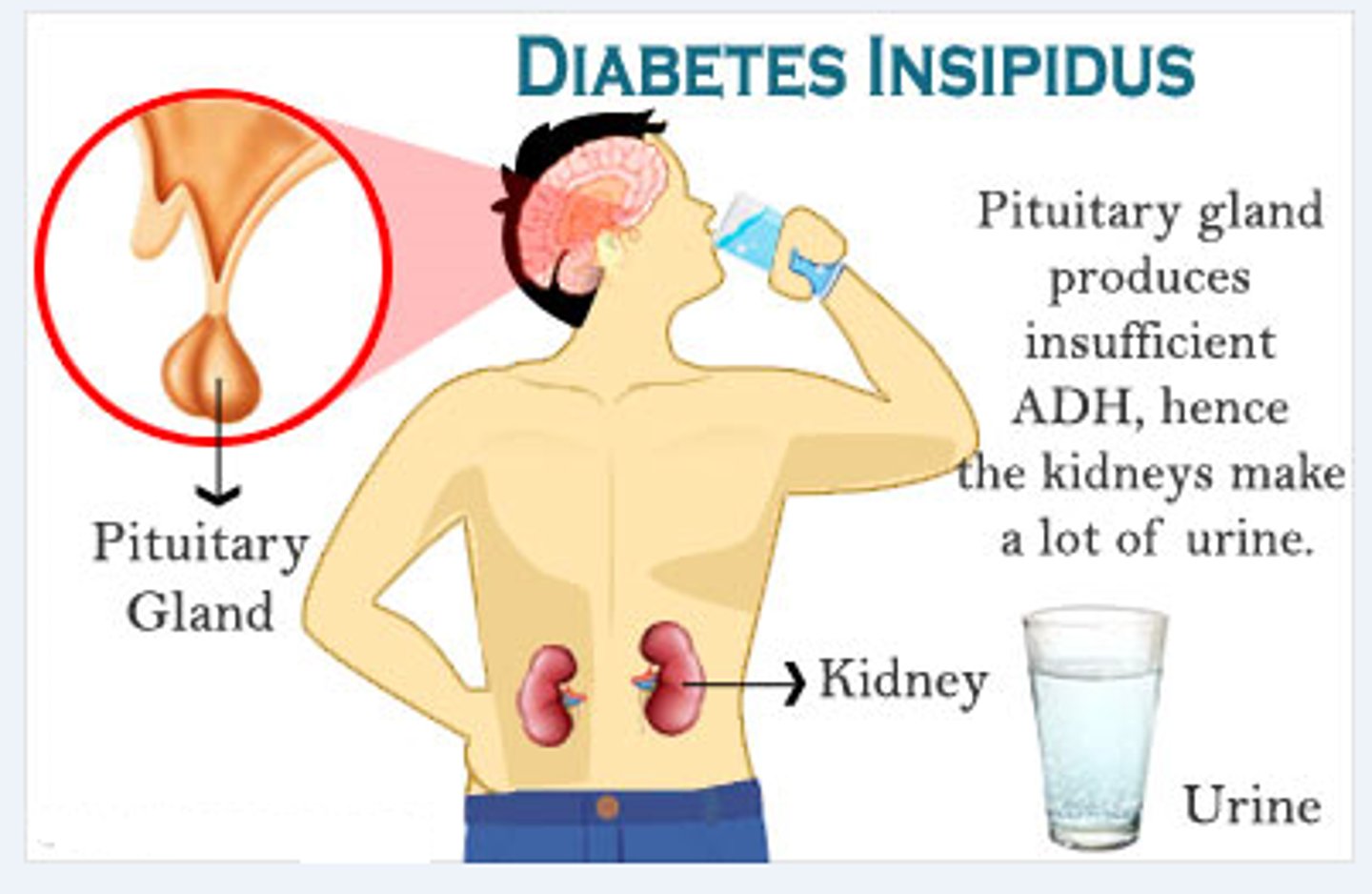 <p>Diabetes insipidus is caused by low ADH levels or the kidneys not responding to ADH, often due to pituitary damage, brain injury, surgery, or kidney problems.</p><p>Symptoms include extreme thirst, excessive urination, dehydration, diluted urine, and needing to drink water constantly (especially at night).</p>