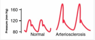 <p>the shape of the pressure wave changes (e.g., arteriosclerosis) </p>