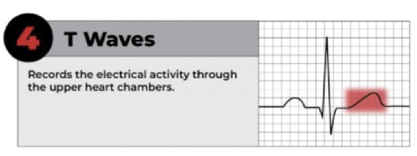 <p>ventricle repolarizes at the beginning of ventricular diastole (relaxation)</p>
