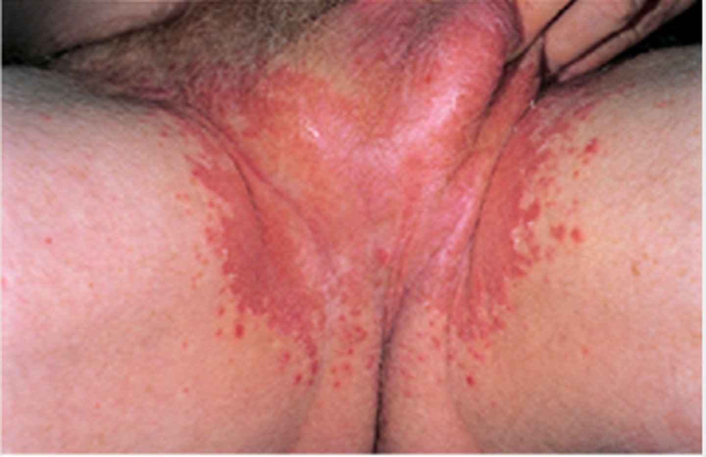 <p>fungal infection of the groin (most common in men); often called "jock itch"</p>