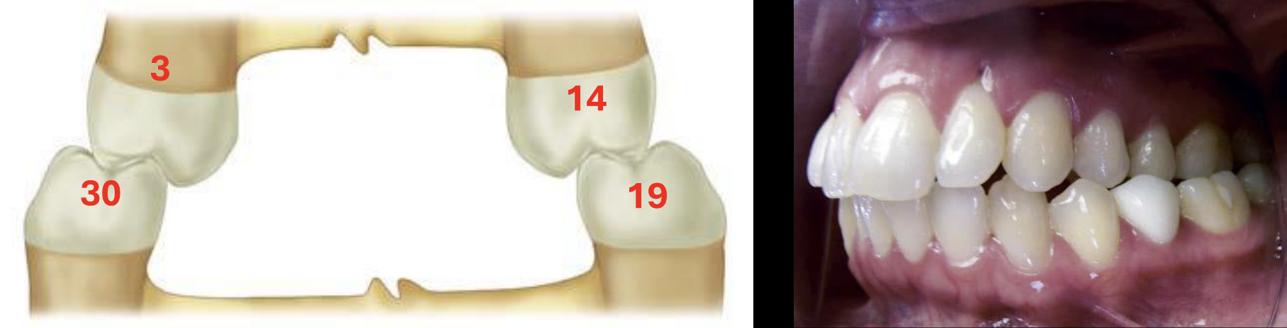 <p>Maxillary buccal cusps contact in central fossa area of mandibular teeth, caused by narrow maxilla compared to mandible </p>