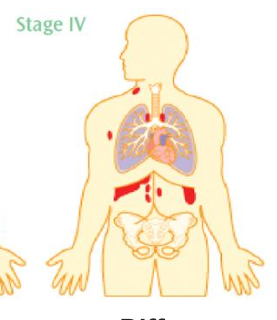 <p>Diffuse involvement of extra-lymphatic organs</p>