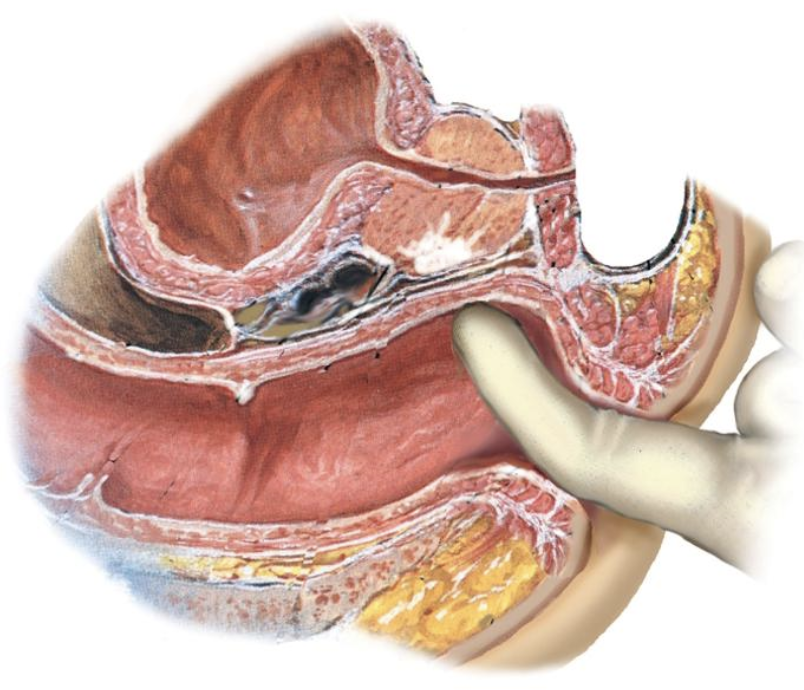 <p>Hard ‬‭area‬‭ on ‬‭prostate ‬‭or‬‭ hard‬ fixed, irregular nodules on prostate‬</p>