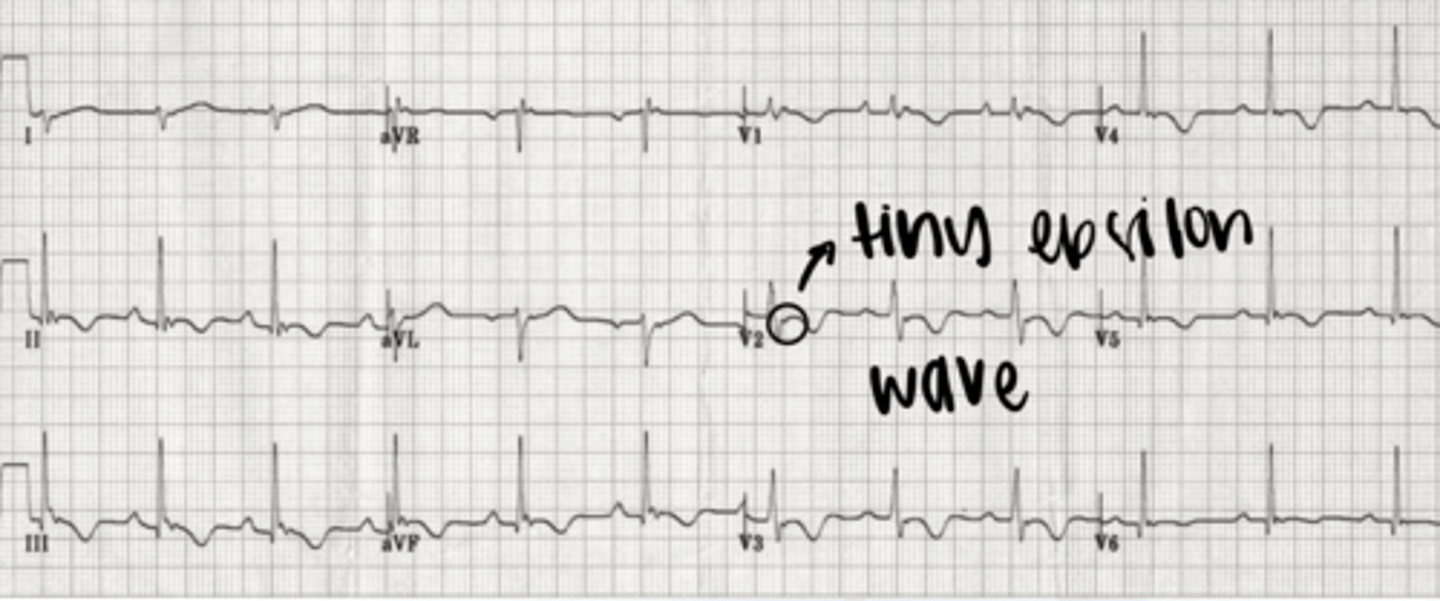 <p>- prolonged S-wave upstroke</p><p>- epsilon wave: small positive deflection at end of QRS that is similar to a "fishhook"</p><p>- inversion of T waves in right chest leads</p>