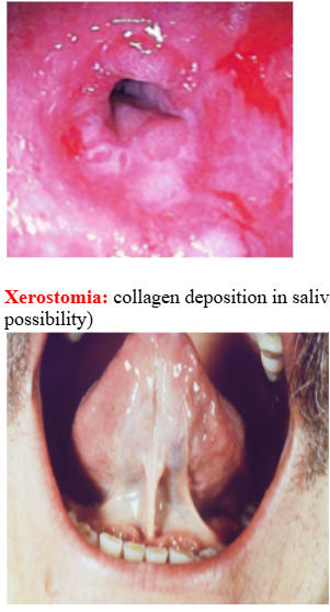 <p><span style="background-color: transparent; font-family: "Times New Roman", serif;"><strong>*Microstomia:</strong> limitation of mouth opening due to collagen deposition in perioral skin (70%)</span></p><p><span style="background-color: transparent; font-family: "Times New Roman", serif;"><strong>*Purse String-Like Mouth:</strong> furrows radiating from mouth</span></p><p><span style="background-color: transparent; font-family: "Times New Roman", serif;"><strong>*Loss of attached gingival mucosa and multiple gingival recession</strong></span></p><p><span style="background-color: transparent; font-family: "Times New Roman", serif;">  - decreased vascularity and tissue ischemia resulting in increased periodontal disease and tooth mobility</span></p><p><span style="background-color: transparent; font-family: "Times New Roman", serif;"><strong>*Dysphagia: </strong>collagen deposition in lingual and esophageal mucosa produces firm, hypomobile tongue and inelastic esophagus → hinders swallowing</span></p><p><span style="background-color: transparent; font-family: "Times New Roman", serif;"><strong>*Xerostomia: </strong>collagen deposition in salivary gland tissues (secondary Sjogren Syndrome a possibility)<strong><br>*Diffuse widening of the periodontal ligament space</strong> </span></p><p><span style="background-color: transparent; font-family: "Times New Roman", serif;">(increased collagen synthesis in PDL)1</span><br><span style="background-color: transparent; font-family: "Times New Roman", serif;"><strong>*Resorption of posterior ramus of the mandible, coronoid process, chin, condyle</strong> (+individual tooth resorption): due to increases pressure from collagen production</span></p>