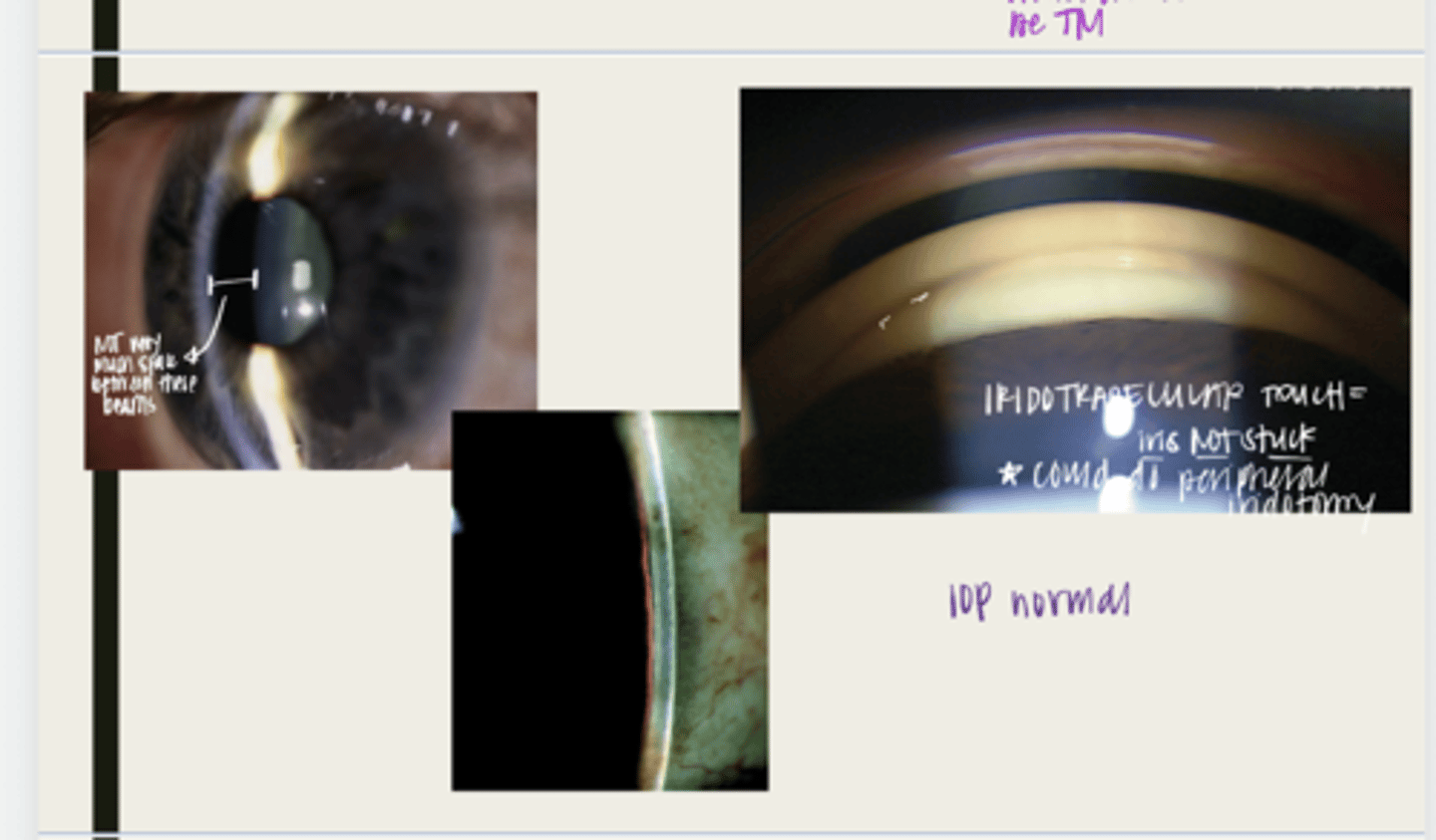 <p>With a primary angle closure suspect, will there be ANY adhesions of the iris and the TM?</p>