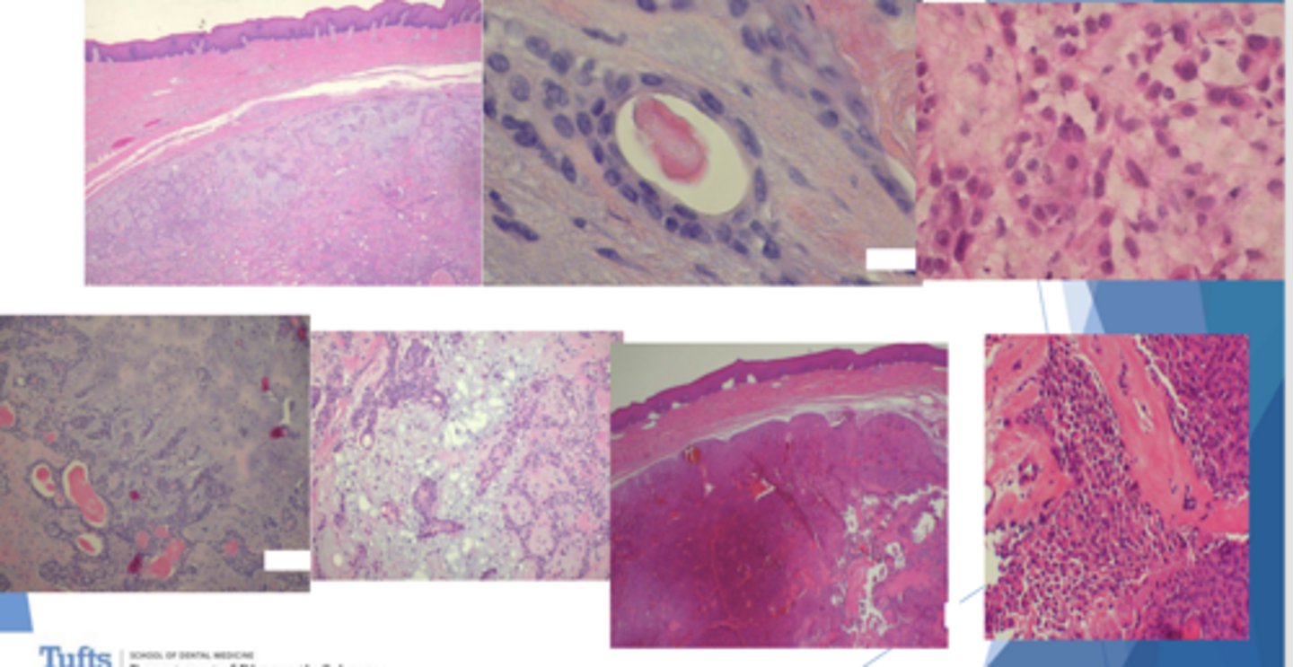 <p>ID the pathology based on the histology findings:</p><p>- Usually well-circumscribed if not encapsulated</p><p>- Double-layered ducts</p><p>- Plasmacytoid cells</p>