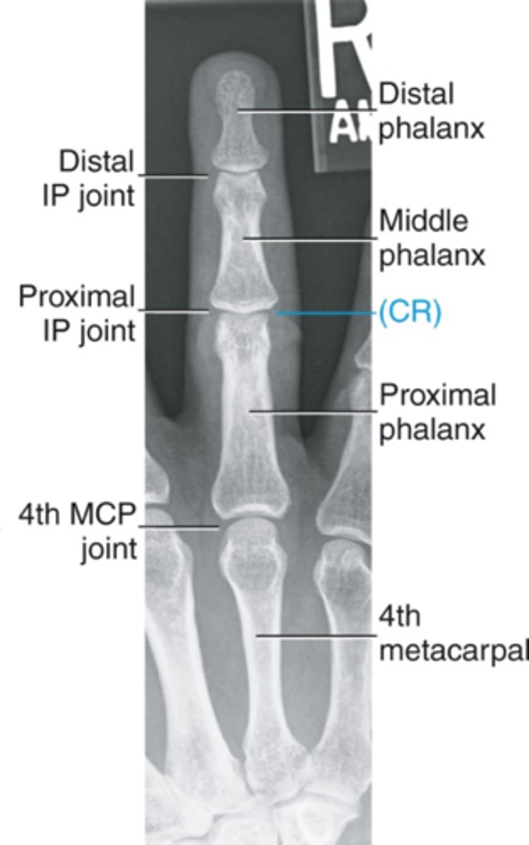 <p>-Equal concavity on both sides</p><p>-Open IP and MCP joint spaces</p><p>-Entire digit from fingertip to distal portion of adjoining metacarpal</p>