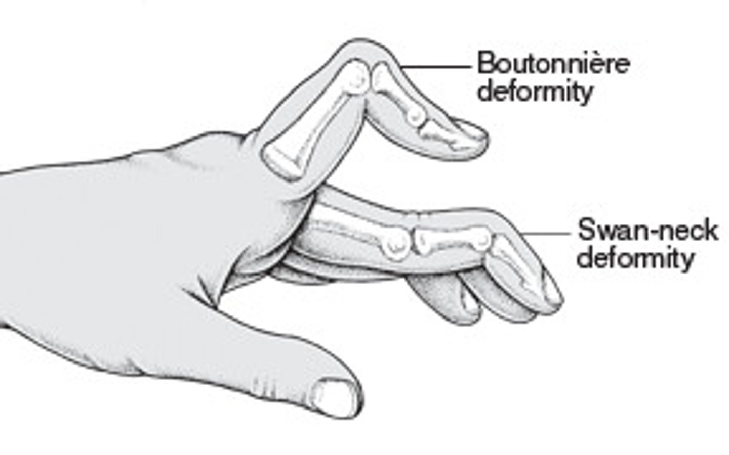 <p>caused by chronic RA, swan neck- flexion contracture of metacarp. boutonniere- knuckle looks as if pushed</p>