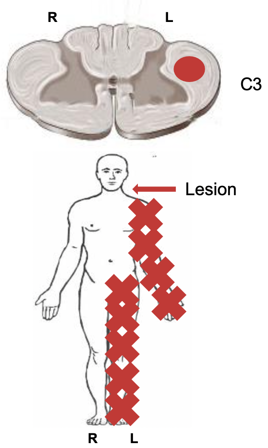 <p><span style="font-family: ArialMT">A lesion to the </span><strong><em><u><span style="font-family: ArialMT">left lateral CST at C3</span></u></em></strong><span style="font-family: ArialMT"> causes </span><strong><em><u><span style="font-family: ArialMT">UMN signs </span></u></em></strong><span style="font-family: ArialMT">- weakness, paralysis, hyperreflexia, and hypertonicity - in the </span><strong><em><u><span style="font-family: ArialMT">left arm</span></u></em></strong><span style="font-family: ArialMT"> and </span><strong><em><u><span style="font-family: ArialMT">leg</span></u></em></strong><span style="font-family: ArialMT"> (at C4 myotome and below)</span></p>