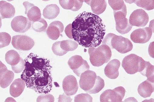 <ul><li><p>rare genetic disorder</p></li><li><p>associated with coarse, dark granules in <strong>ALL </strong>WBCs</p></li><li><p>granules thought to be lipid deposits</p></li></ul><p></p>