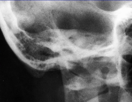 <p>What is this x-ray demonstrating?</p>