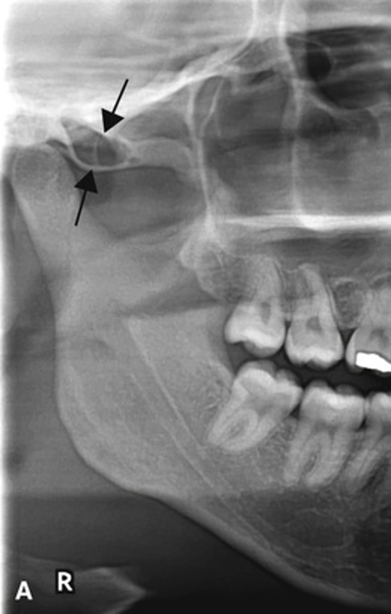 <p>Radiograph shows?</p>
