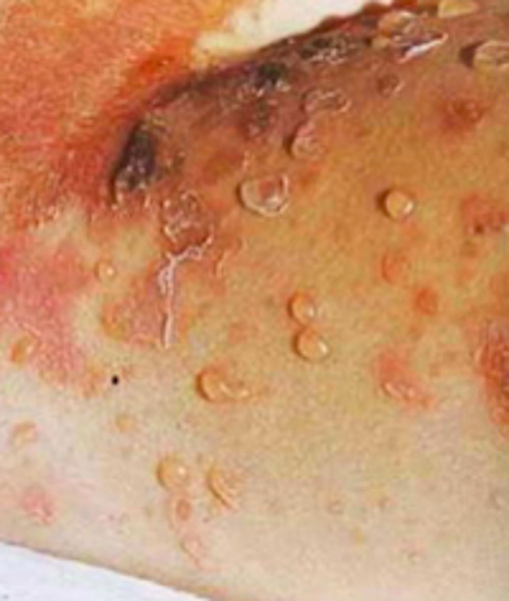 <p>Bacterial Skin Infections:</p><p>impetigo including blisters containing c<strong>lear, yellow, or slightly purulent fluid</strong> with an erythematous base</p>
