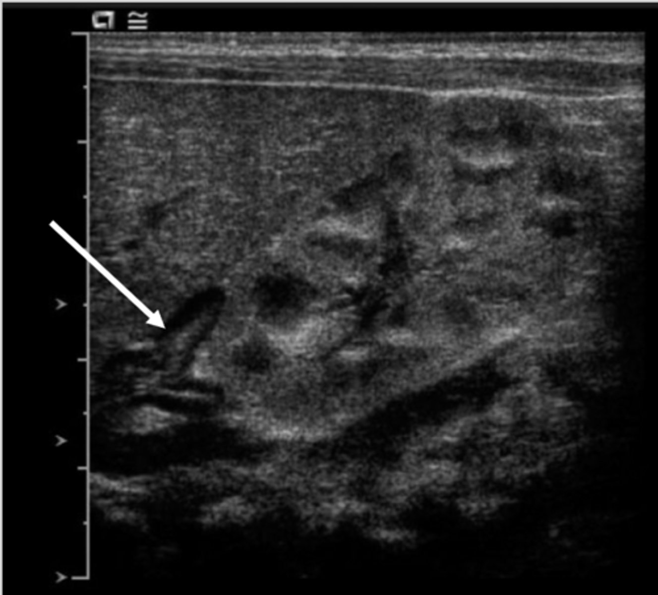<p>Why are adrenal glands so much easier to see in fetuses/neonates?</p>