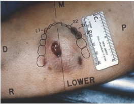 <p>abrasion with more force and less duration</p>
