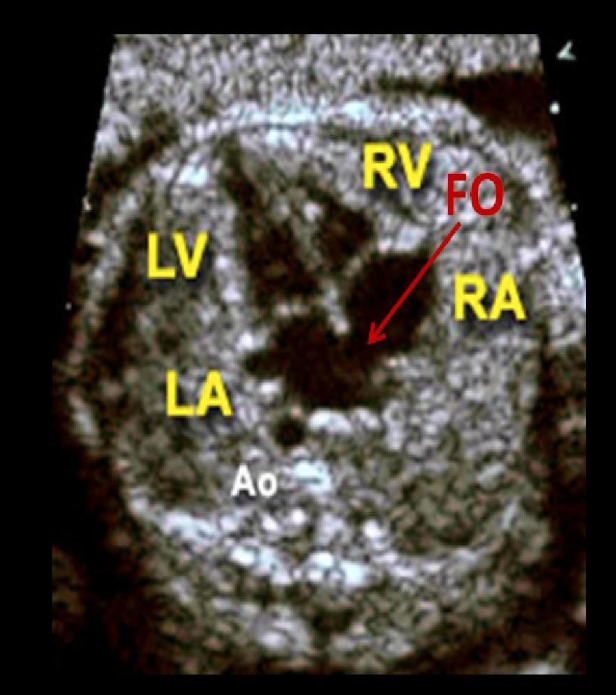 <p>Part of fetal circulation system that connects RA to LA and leaves small indentation after birth called fossa ovalis </p>