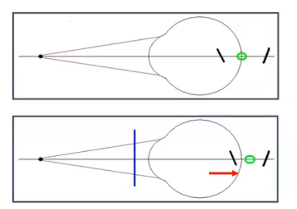 <p>when a minus cyl with approrpoiate axis is added…</p>