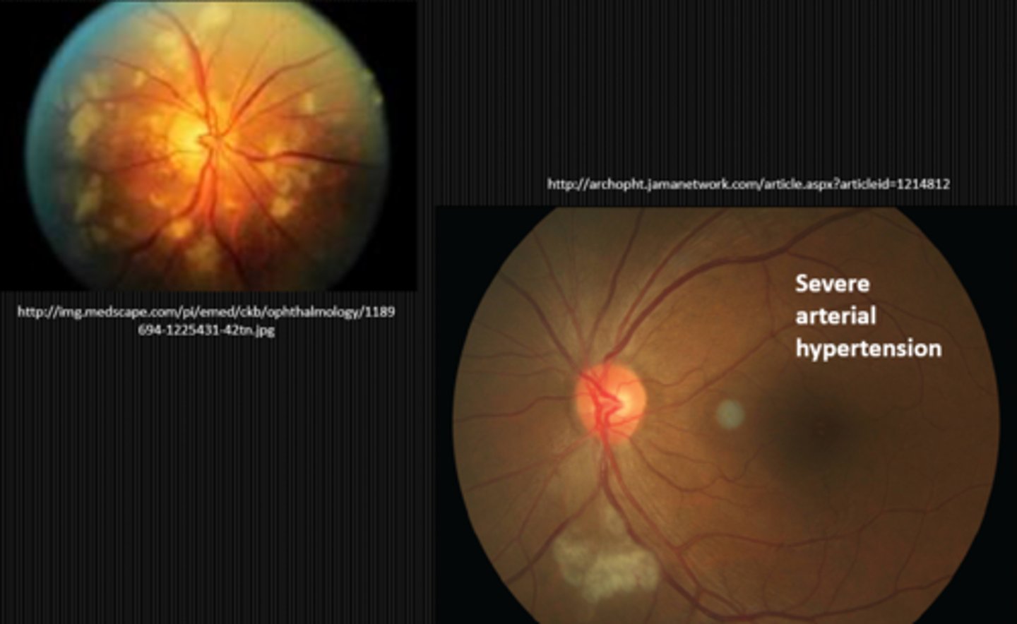 <p>CWS near the ONH</p>