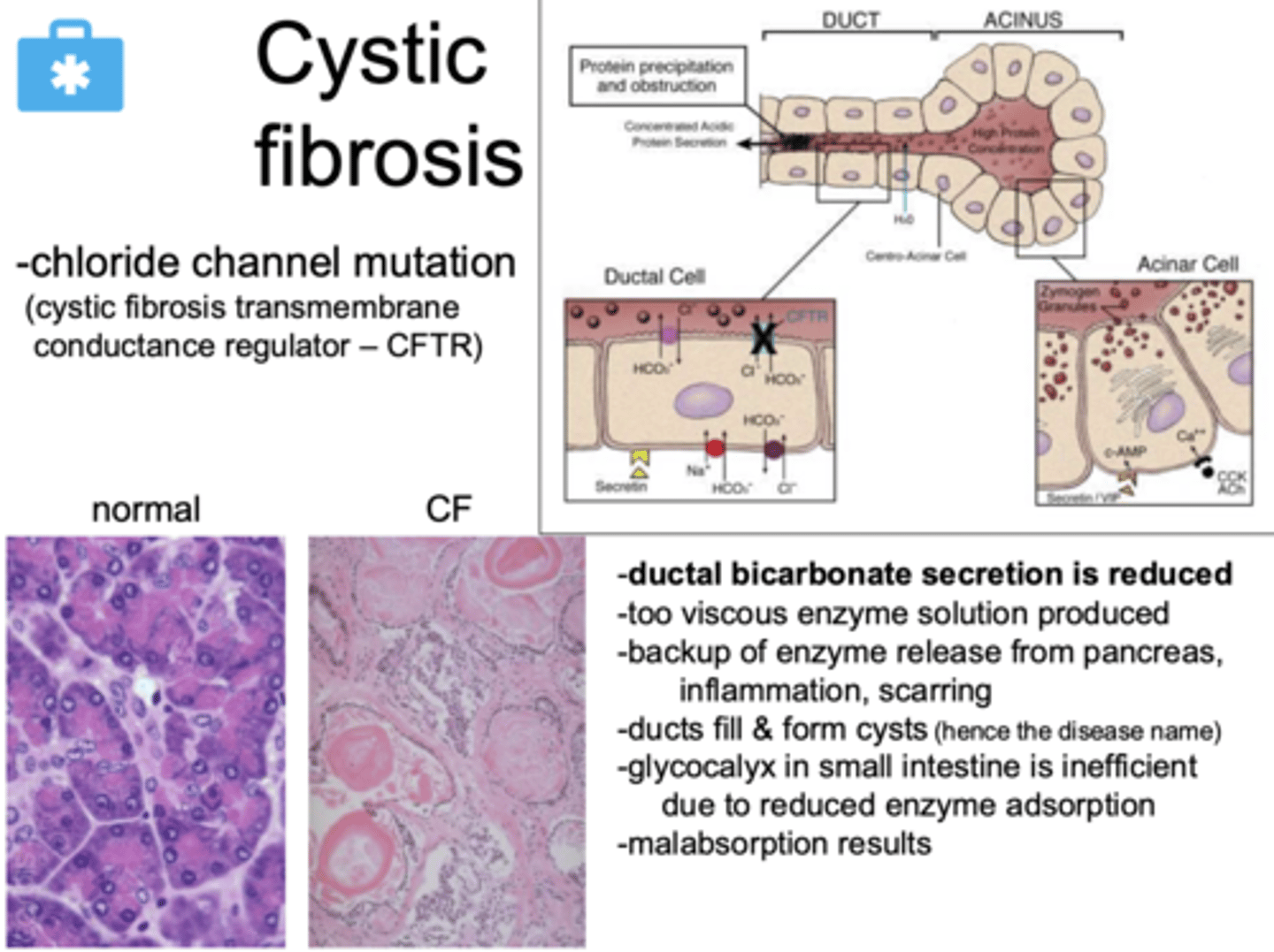 <p>a mutation of chloride channels in the pancreas</p><p>- ductal bicarbonate secretion is reduced</p>
