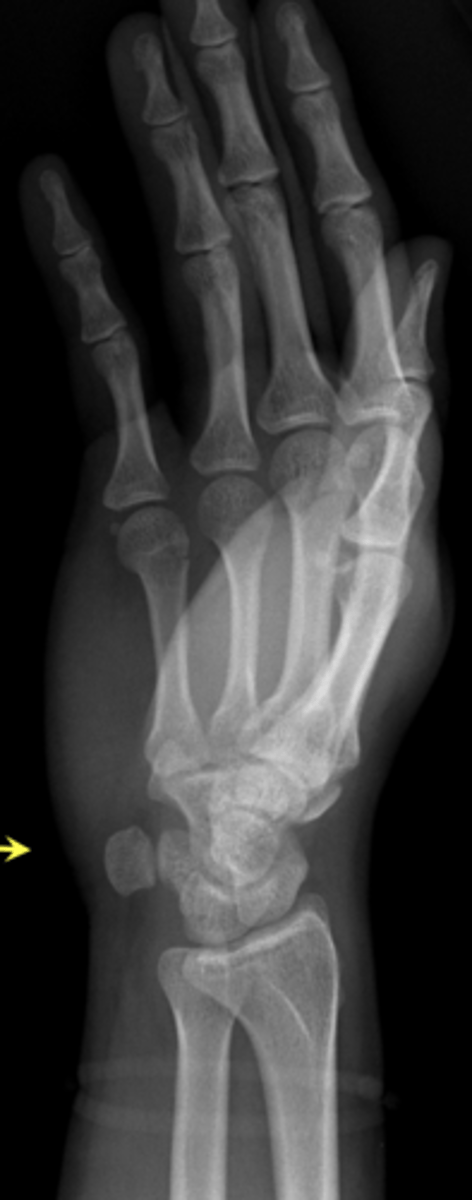 <p>What position is this and what carpal is seen?</p>