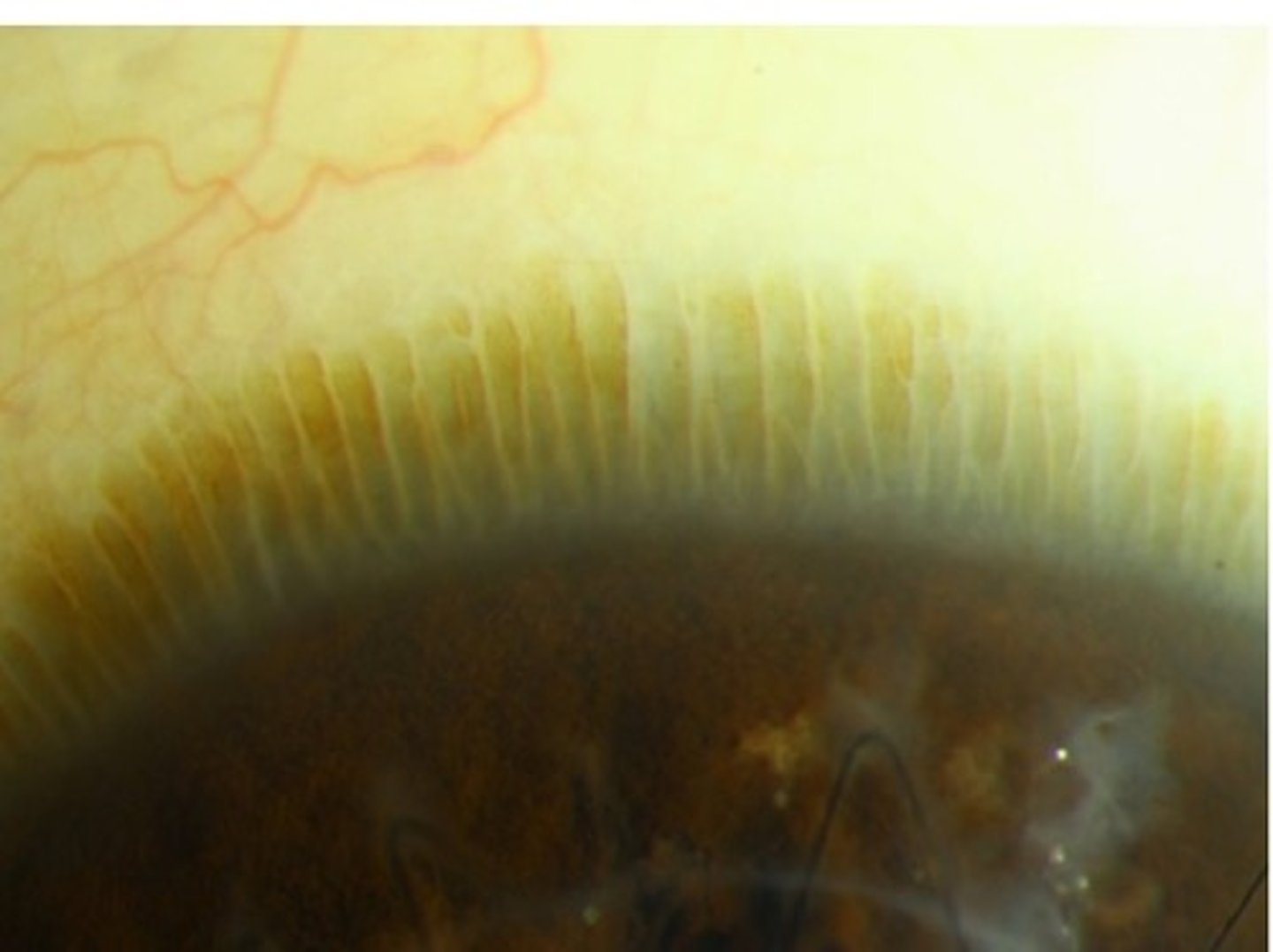 <p>radial projections of limbal epithelium &amp; stroma that extend into cornea in spike-like fashion</p><p>-the alternating pattern of epithelial thickening and thinning that outline fibrovascular connective tissue channels containing arterial, venous, and lymphatic vessels</p>