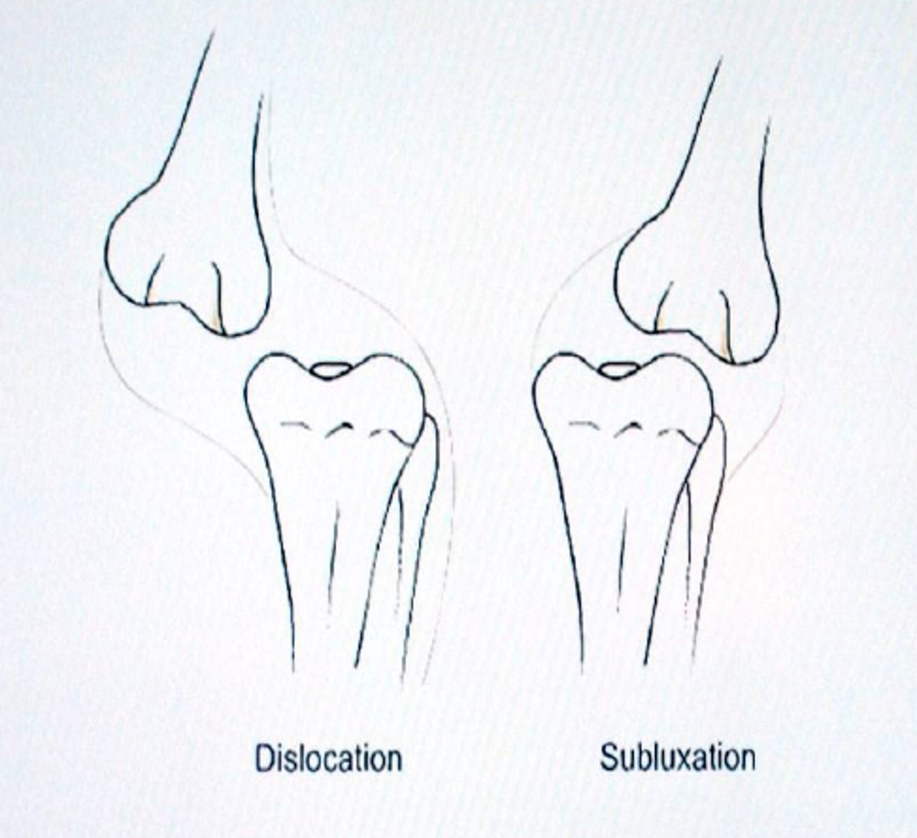 <p>partial or incomplete separation of a joint</p>