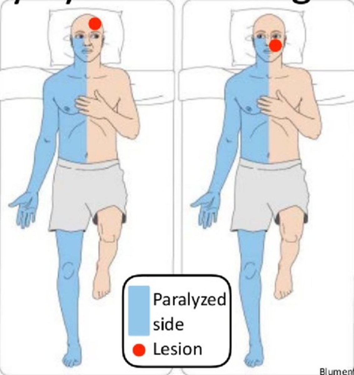 <p>TOWARD</p><p>(ex: involvement of abducens nucleus or PPRF --&gt; ipsilateral gaze weakness --&gt; eyes drift AWAY from the side of lesion)</p>