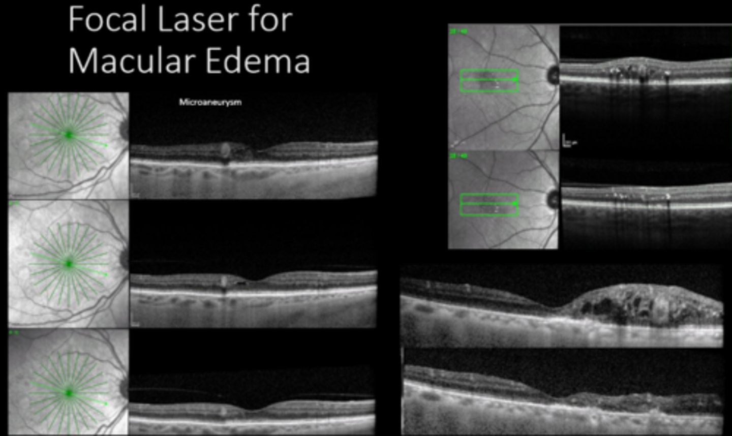 <p>What were 2 outcomes of the ETDRS 1989 study?</p>