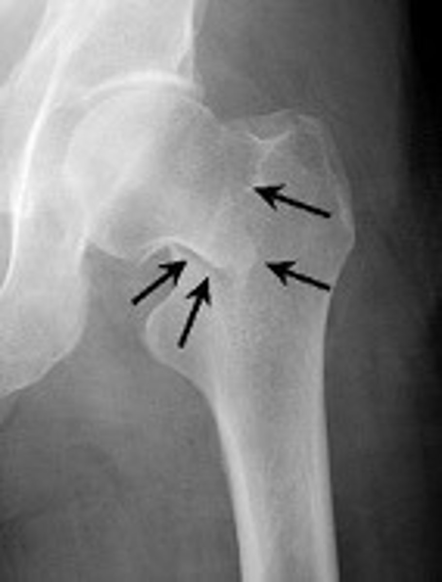 <p>one fragment firmly driven into another (shaft into head; common in proximal end of femur, humerus, ulna)</p>