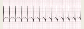 Sinus rhythm – normal P wave and other measurements WNL

Rate > 100 bpm