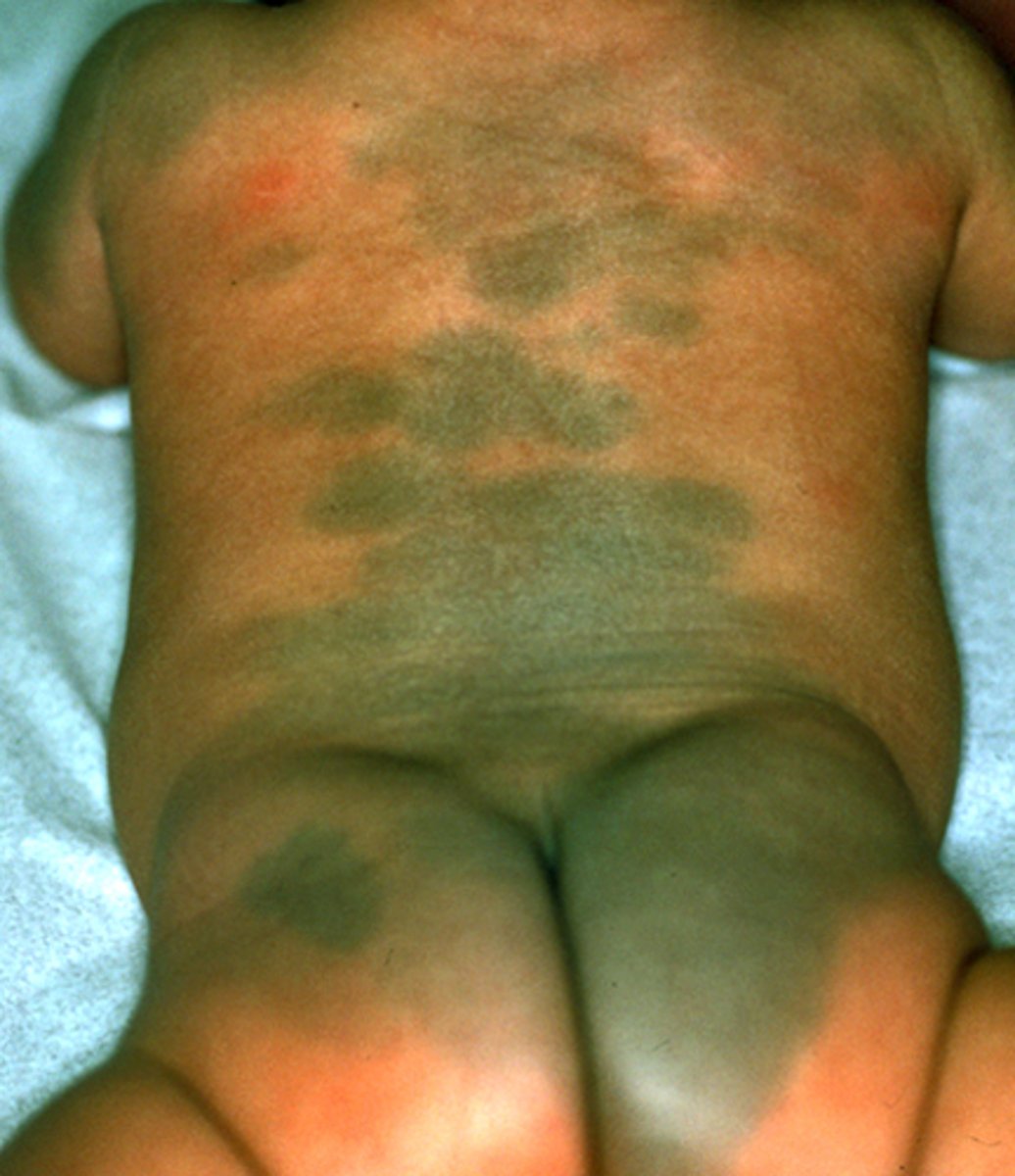 <p>Congenital dermal melanocytosis, formerly called Mongolian spot, is the most frequently encountered pigmented lesion in ոеwbоrոѕ</p><p>Clinical presentation – Congenital dermal melanocytosis typically appears as a blue-gray, pigmented patch with ill-defined borders, although it can also be greenish-blue or brown (picture 10). The diameter of the lesion may be 10 cm or more.</p><p>The sacral area and medial buttocks are the most common sites where active dermal melanocytes frequently remain at birth, but they can also be seen at extrasacral ("aberrant") sites (eg, the superior or anterior trunk). They rarely occur on the head, face, or flexor surface of the extremities.</p><p>●Clinical course – Congenital dermal melanocytosis is completely benign and usually fades during the first or second year of life [16]. By 6 to 10 years of age, the vast majority have disappeared. However, approximately 3 percent remain into adulthood, particularly those in extrasacral locations.</p><p>●Diagnosis – Although the distinctive clinical appearance of ill-defined, homogeneous, gray-blue patches is usually diagnostic, particularly when located in classic sites, dermal melanocytosis can be misinterpreted as bruises (which tend to change color and resolve more quickly), resulting in erroneous accusations of child abuse [12]. It is thus prudent to document these lesions at least upon initial physical examination to avoid confusion with bruises.</p>